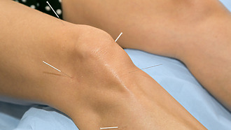 Akupunktur bei Arthrose im Knie